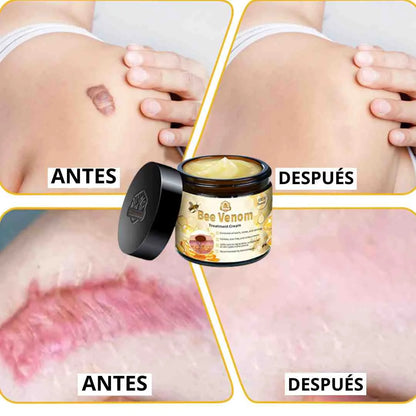 BEE VENOM CICATRICES Y MANCHAS