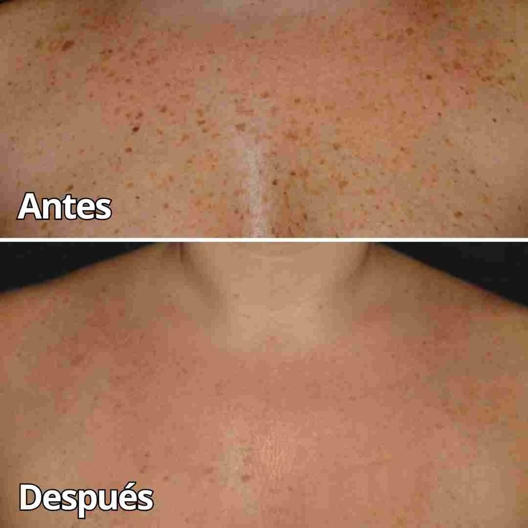 BEE VENOM CICATRICES Y MANCHAS